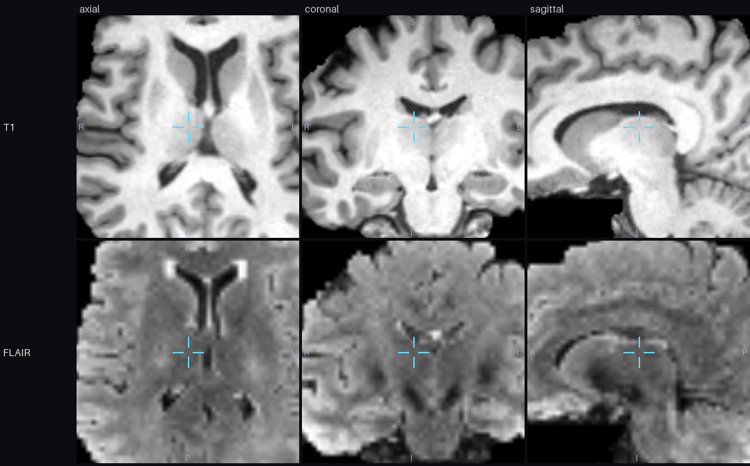 Actual MCP view_region image response showing T1 and FLAIR crops from the public MRI